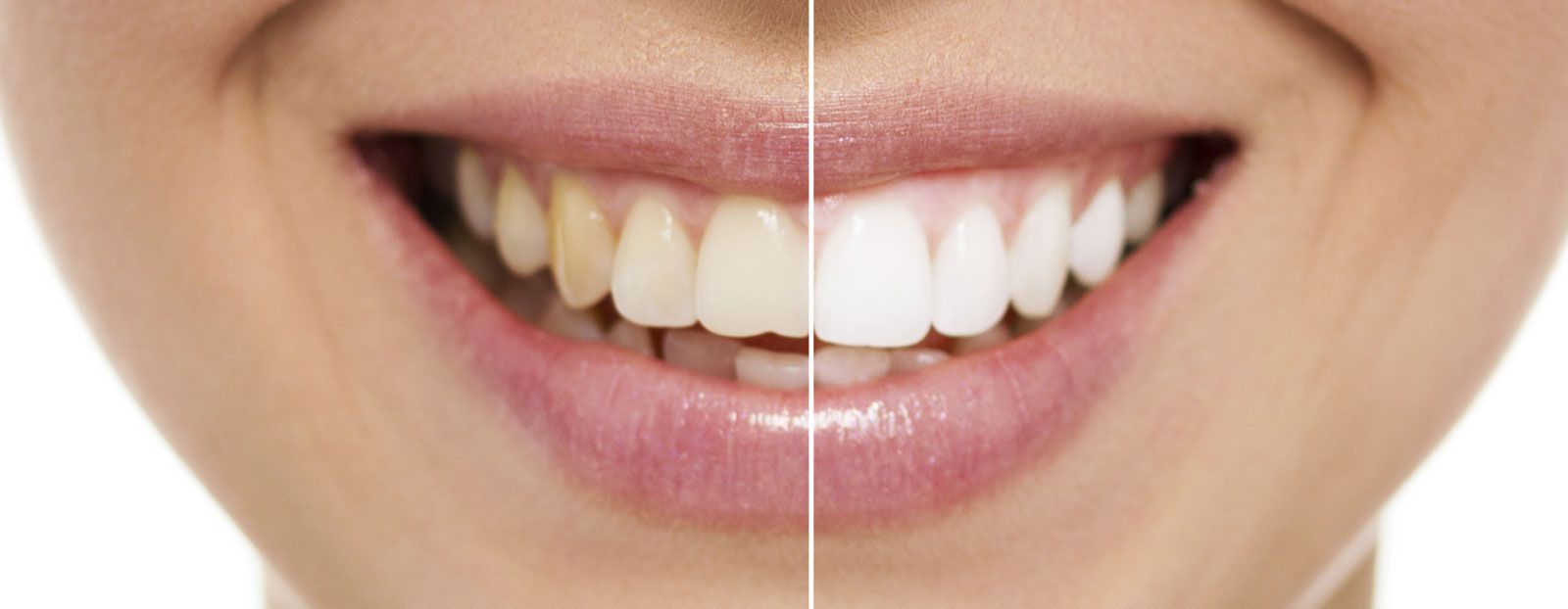 Teeth Whitening Dayton, OH