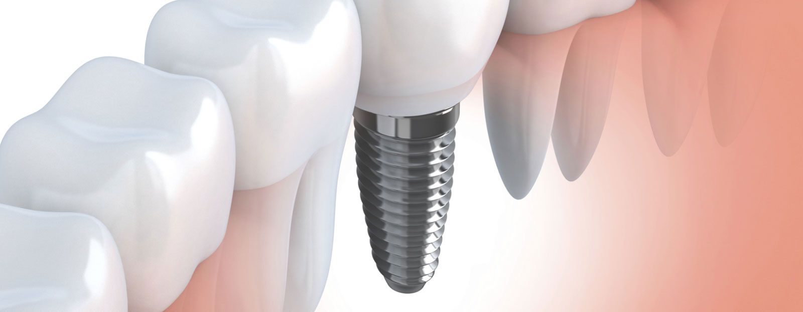 Dental Implants Dayton, OH