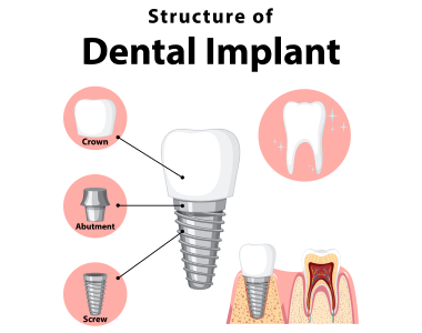 Dental Implants Beavercreek Ohio